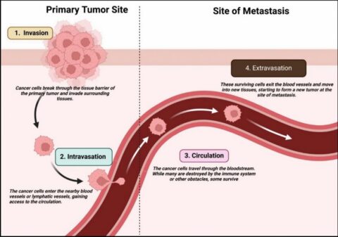 Diagram showing cancer metastasis: At the tumor site, cells invade tissue, then enter blood vessels (intravasation). They travel in the bloodstream (circulation) and exit vessels to form new tumors in tissues (extravasation).